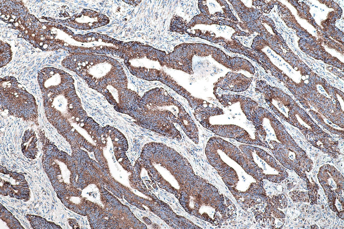 Immunohistochemical analysis of paraffin-embedded human colon cancer tissue slide using KHC0179 (TRMT10C IHC Kit).