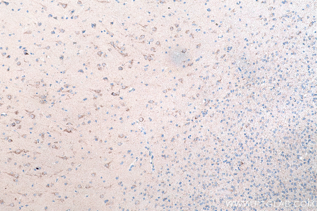 Immunohistochemical analysis of paraffin-embedded human gliomas tissue slide using KHC0179 (TRMT10C IHC Kit).