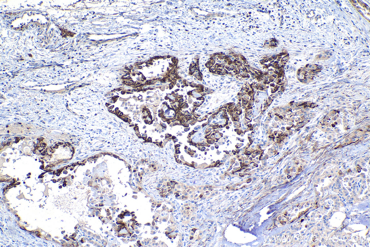 Immunohistochemical analysis of paraffin-embedded human thyroid cancer tissue slide using KHC1182 (TRMT2B IHC Kit).