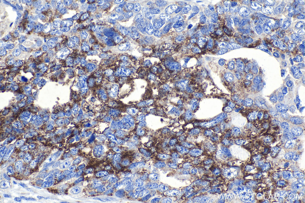 Immunohistochemical analysis of paraffin-embedded human ovary tumor tissue slide using KHC1182 (TRMT2B IHC Kit).