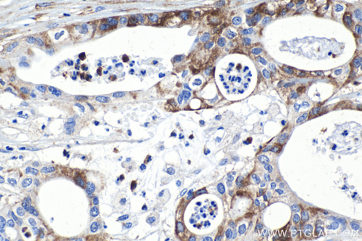 Immunohistochemical analysis of paraffin-embedded human pancreas cancer tissue slide using KHC1182 (TRMT2B IHC Kit).