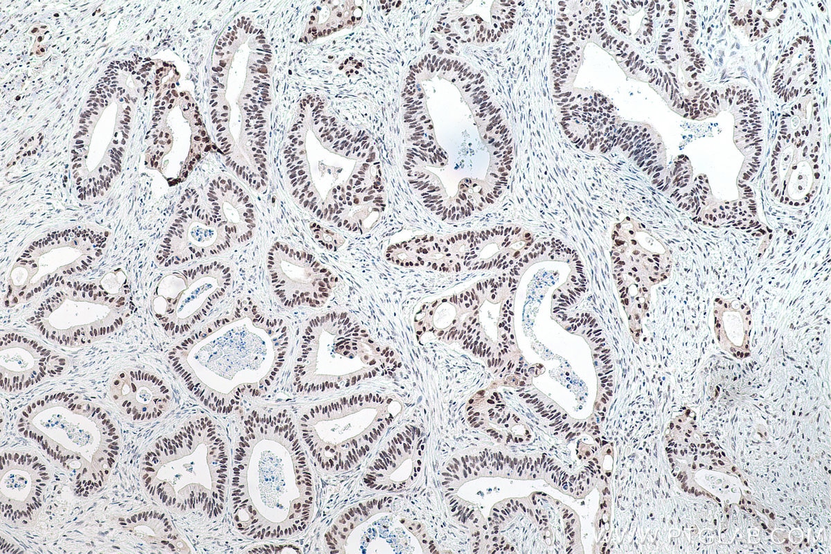 Immunohistochemical analysis of paraffin-embedded human colon cancer tissue slide using KHC0177 (TRMT6 IHC Kit).