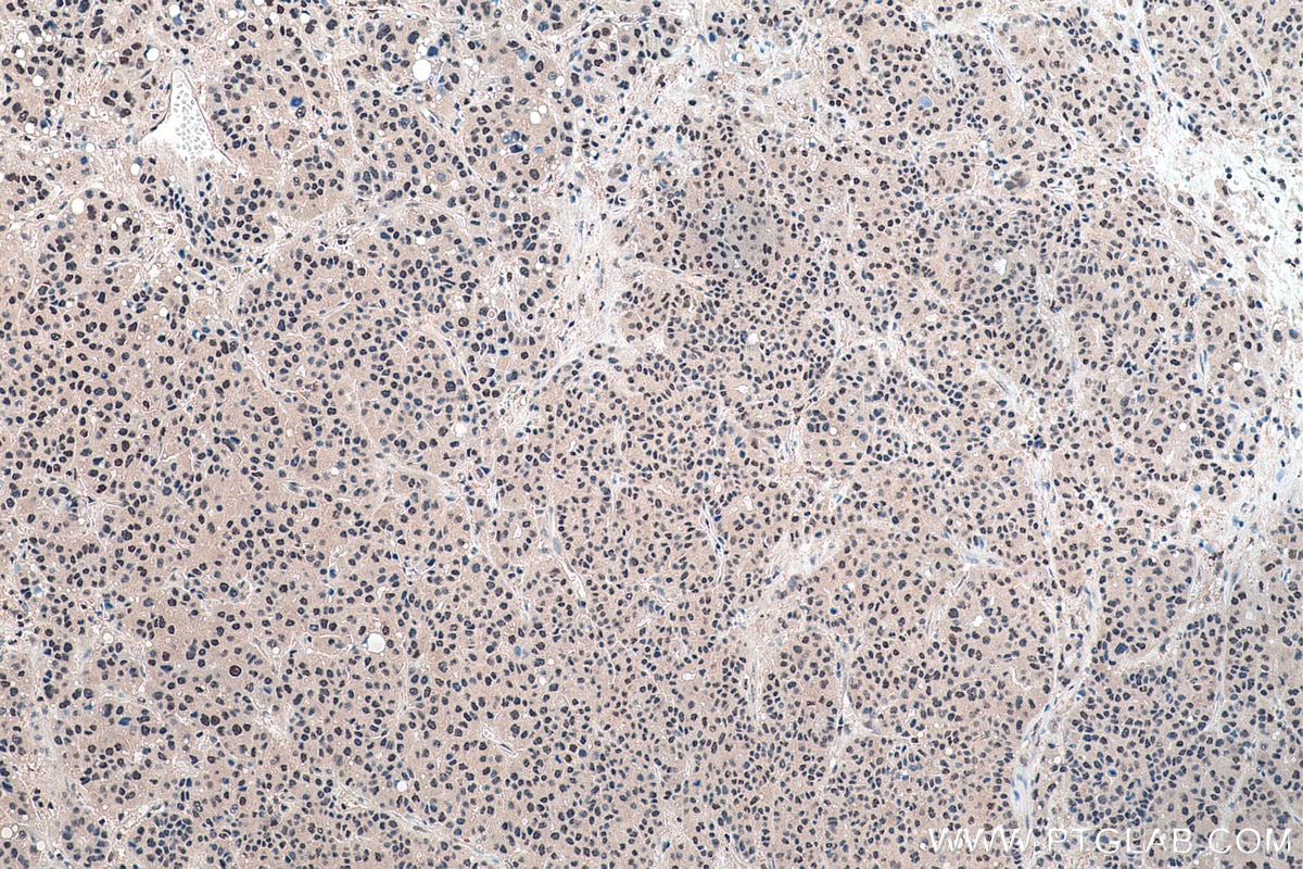 Immunohistochemical analysis of paraffin-embedded human liver cancer tissue slide using KHC0177 (TRMT6 IHC Kit).