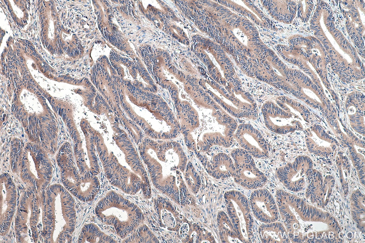 Immunohistochemical analysis of paraffin-embedded human colon cancer tissue slide using KHC0178 (TRMT61B IHC Kit).