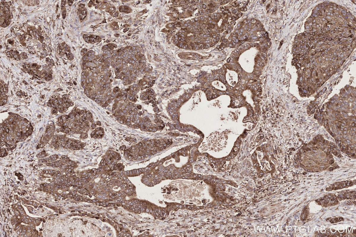 Immunohistochemical analysis of paraffin-embedded human stomach cancer tissue slide using KHC2723 (TRPC4AP IHC Kit).