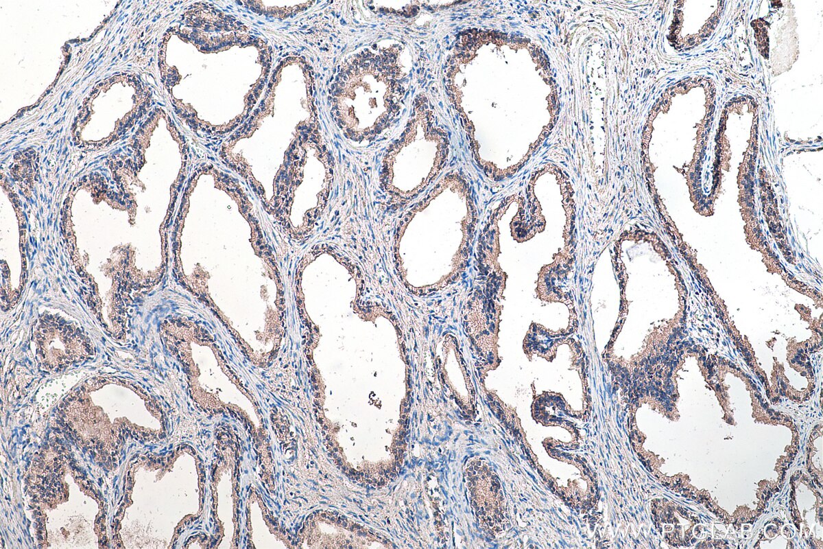 Immunohistochemical analysis of paraffin-embedded human prostate cancer tissue slide using KHC0185 (TRUB2 IHC Kit).