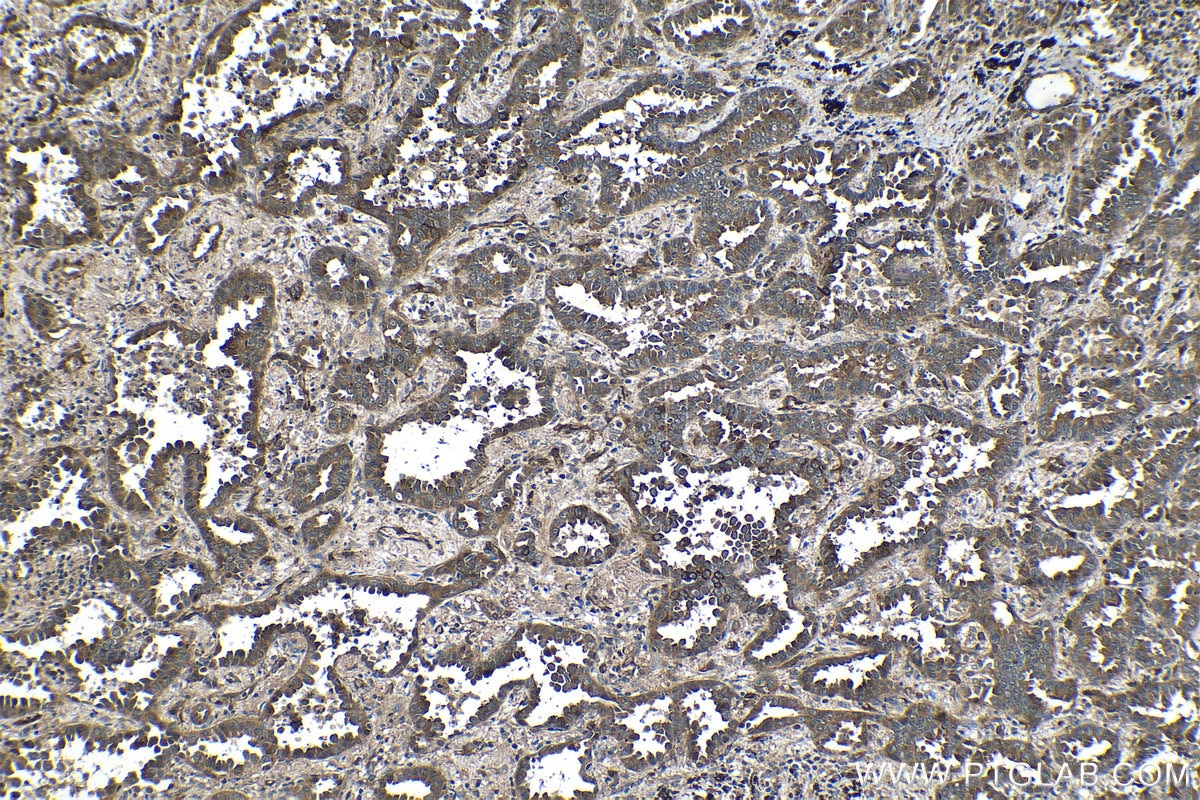 Immunohistochemical analysis of paraffin-embedded human lung cancer tissue slide using KHC1341 (TSC22D1 IHC Kit).