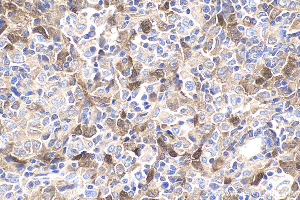 Immunohistochemical analysis of paraffin-embedded human malignant melanoma tissue slide using KHC1891 (TSC22D3/GILZ IHC Kit).