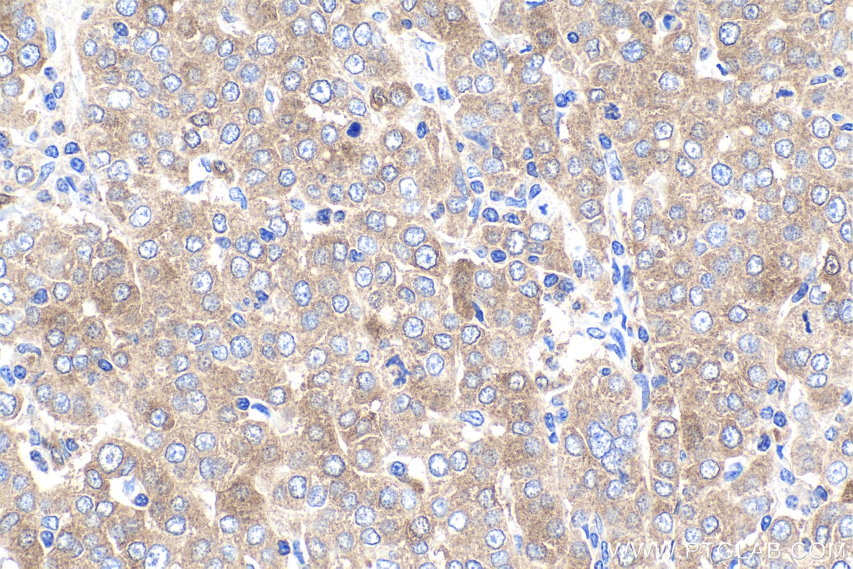 Immunohistochemical analysis of paraffin-embedded human ovary tumor tissue slide using KHC1891 (TSC22D3/GILZ IHC Kit).
