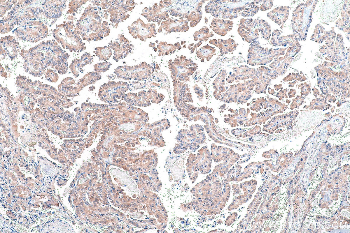 Immunohistochemical analysis of paraffin-embedded human thyroid cancer tissue slide using KHC0903 (TSN IHC Kit).