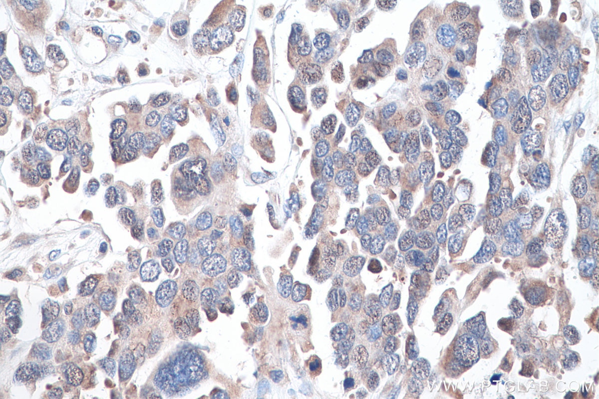 Immunohistochemical analysis of paraffin-embedded human colon cancer tissue slide using KHC0903 (TSN IHC Kit).