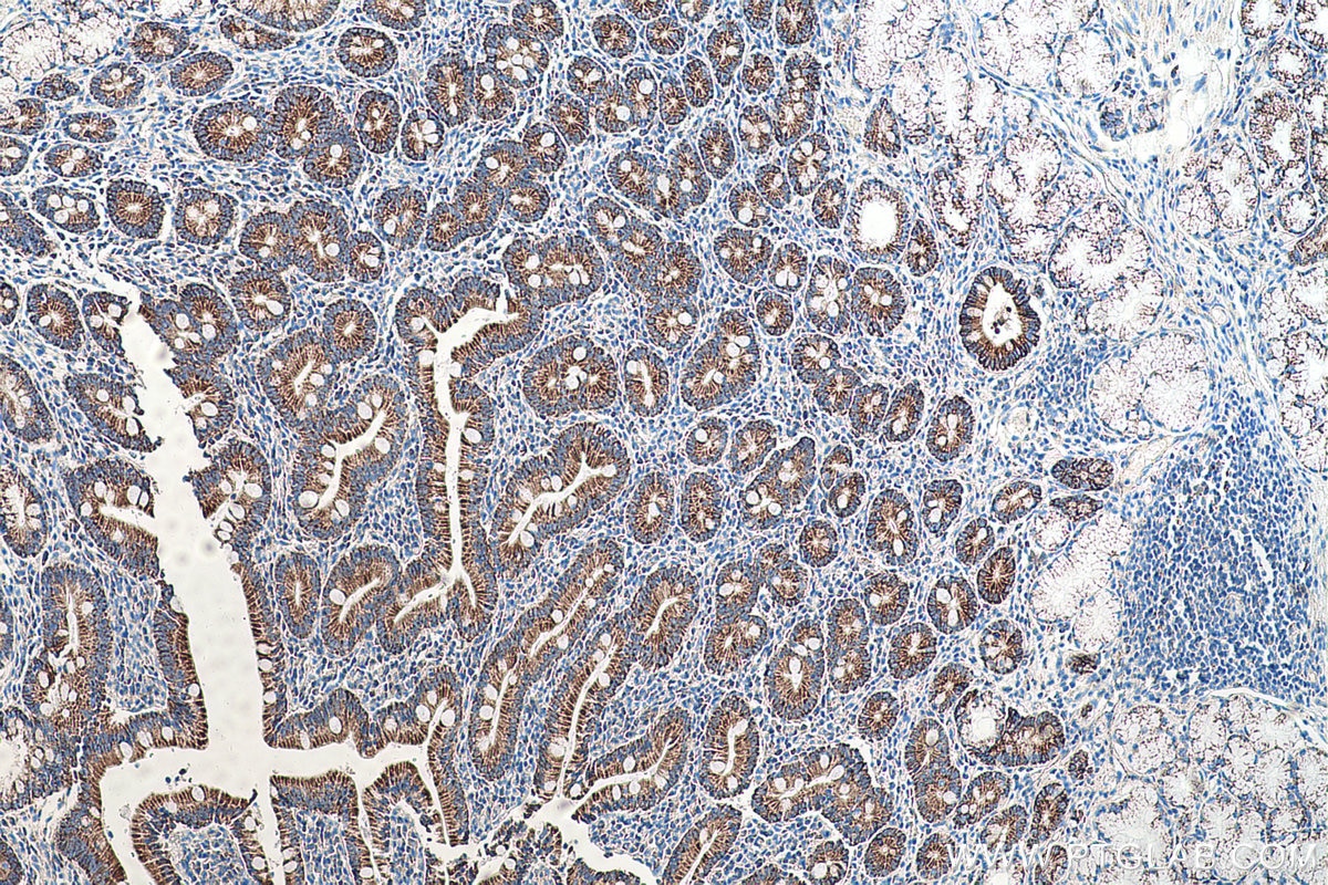 Immunohistochemical analysis of paraffin-embedded human stomach cancer tissue slide using KHC0565 (TST IHC Kit).