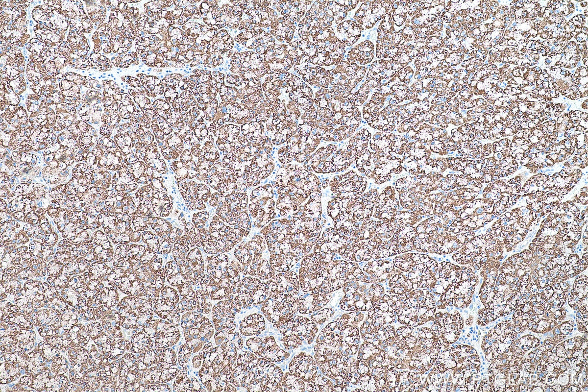 Immunohistochemical analysis of paraffin-embedded human liver cancer tissue slide using KHC0565 (TST IHC Kit).
