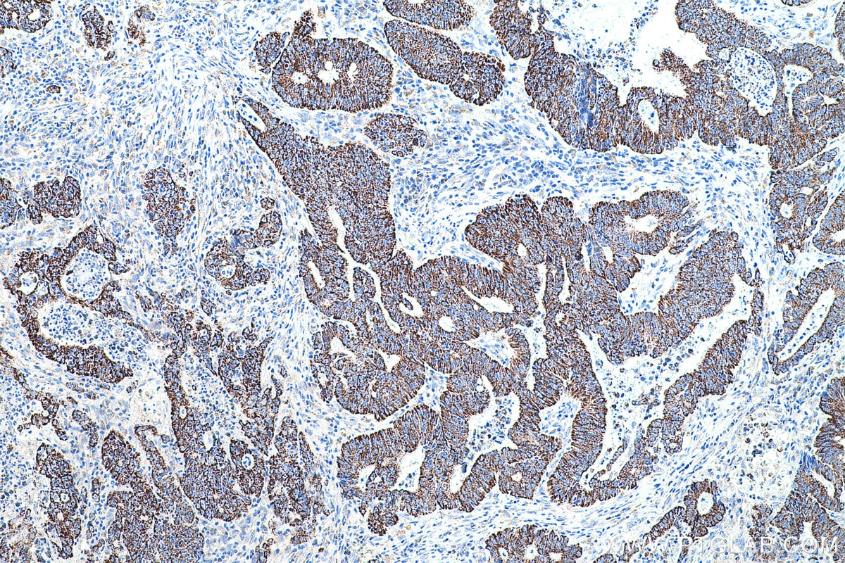 Immunohistochemical analysis of paraffin-embedded human colon cancer tissue slide using KHC0565 (TST IHC Kit).