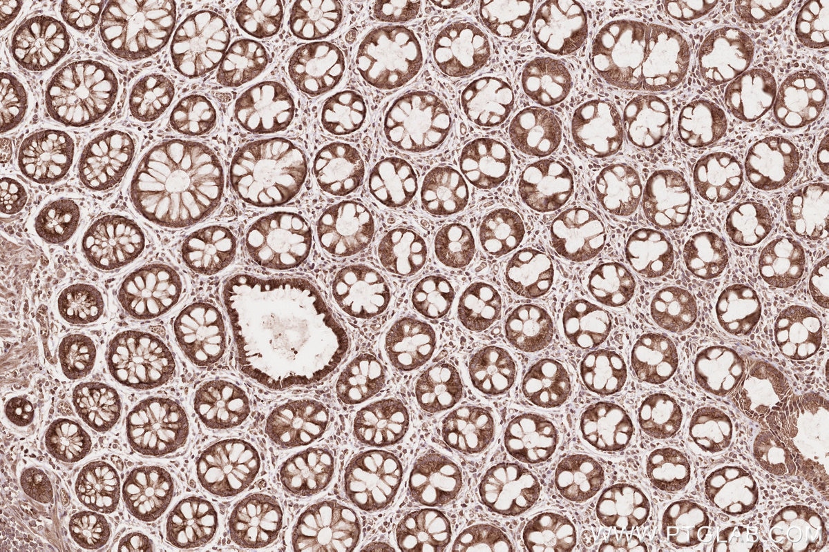 Immunohistochemical analysis of paraffin-embedded human rectal cancer tissue slide using KHC2575 (TTC19 IHC Kit).