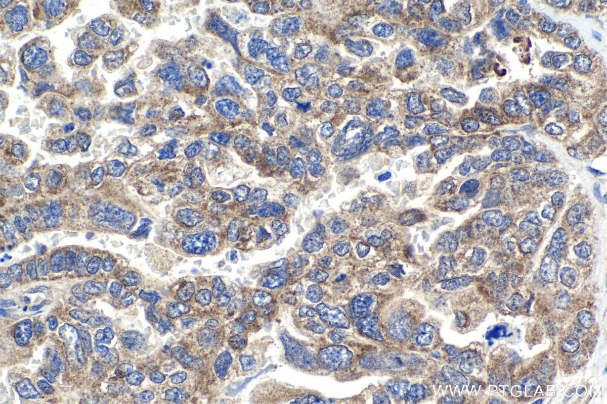 Immunohistochemical analysis of paraffin-embedded human ovary tumor tissue slide using KHC1829 (TTC5 IHC Kit).