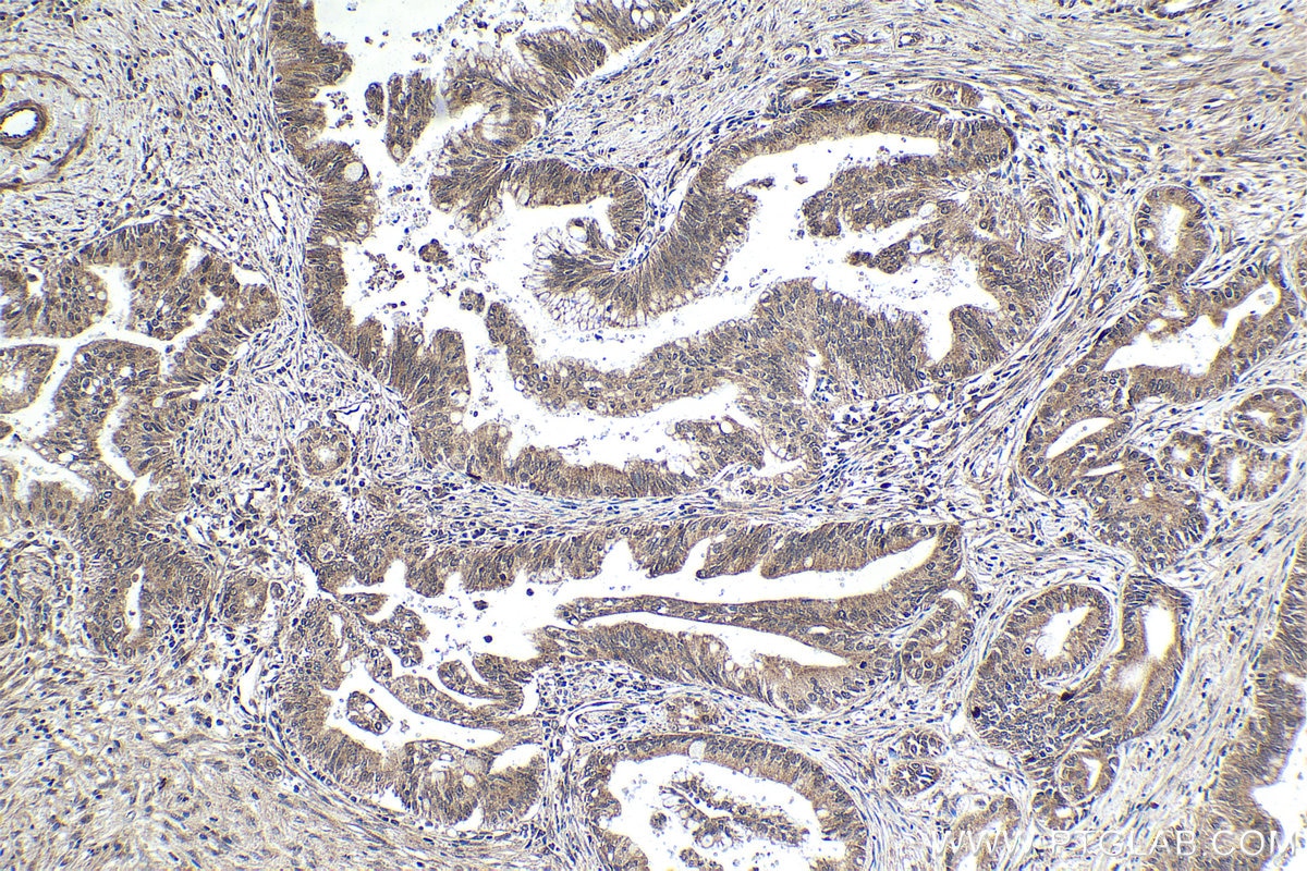 Immunohistochemical analysis of paraffin-embedded human pancreas cancer tissue slide using KHC1829 (TTC5 IHC Kit).