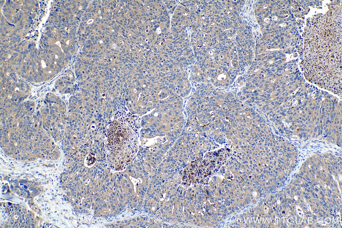 Immunohistochemical analysis of paraffin-embedded human ovary tumor tissue slide using KHC1220 (TTK IHC Kit).