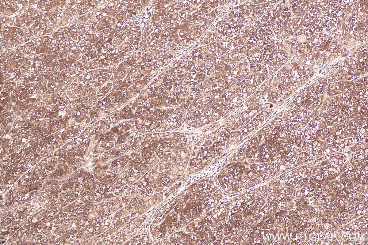 Immunohistochemical analysis of paraffin-embedded human liver cancer tissue slide using KHC0569 (TTPA/TPP1 IHC Kit).