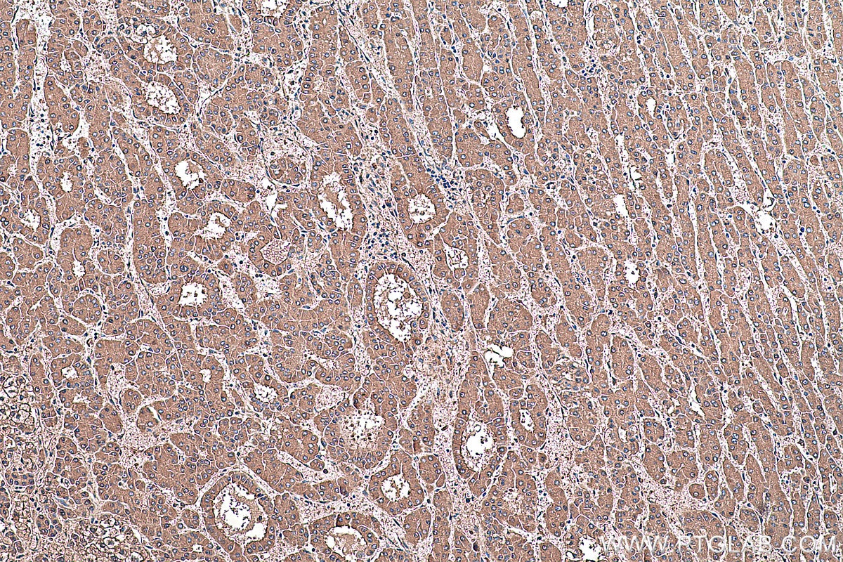 Immunohistochemical analysis of paraffin-embedded human liver cancer tissue slide using KHC0390 (Prealbumin/transthyretin IHC Kit).