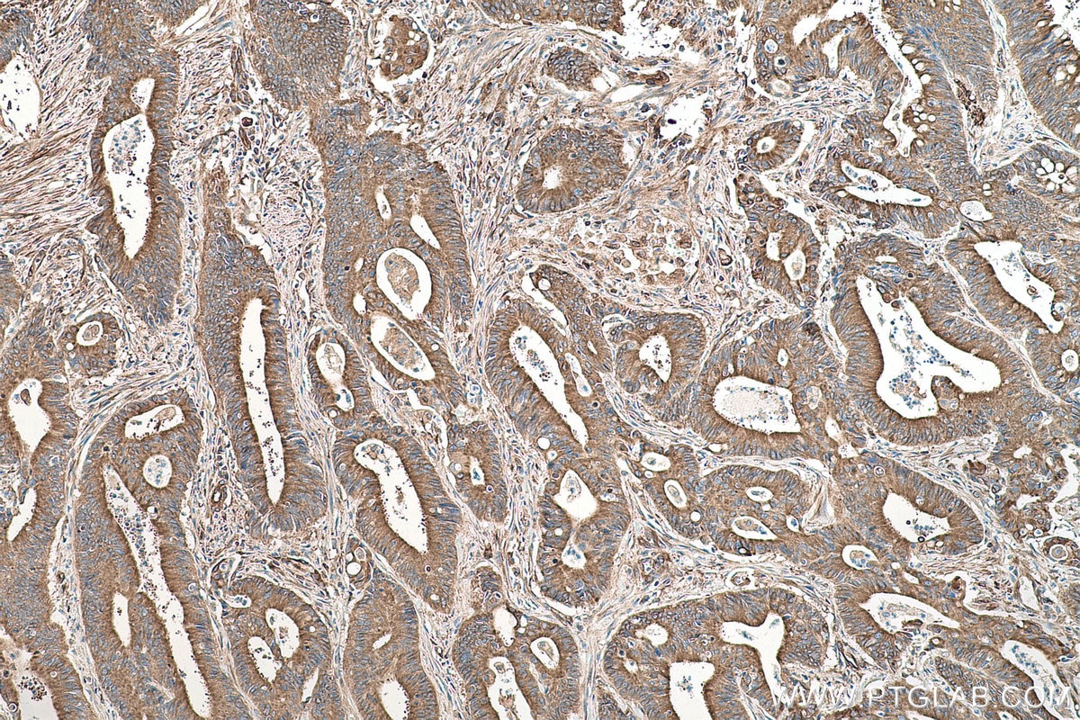 Immunohistochemical analysis of paraffin-embedded human colon cancer tissue slide using KHC0468 (Alpha Tubulin IHC Kit).