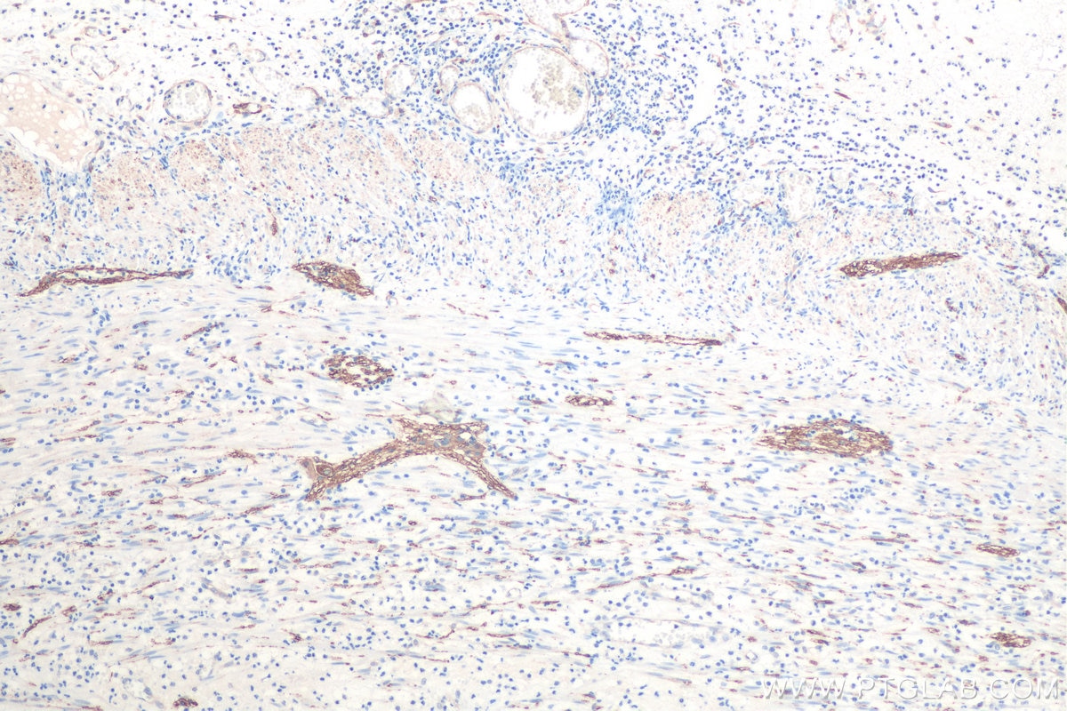 Immunohistochemical analysis of paraffin-embedded human appendicitis tissue slide using KHC0825 (TUBB2B IHC Kit).