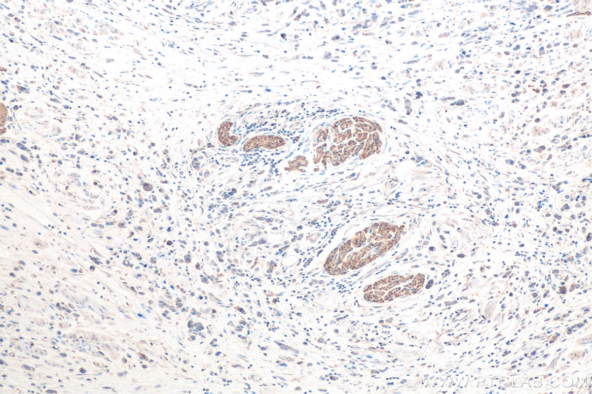 Immunohistochemical analysis of paraffin-embedded human stomach cancer tissue slide using KHC0825 (TUBB2B IHC Kit).