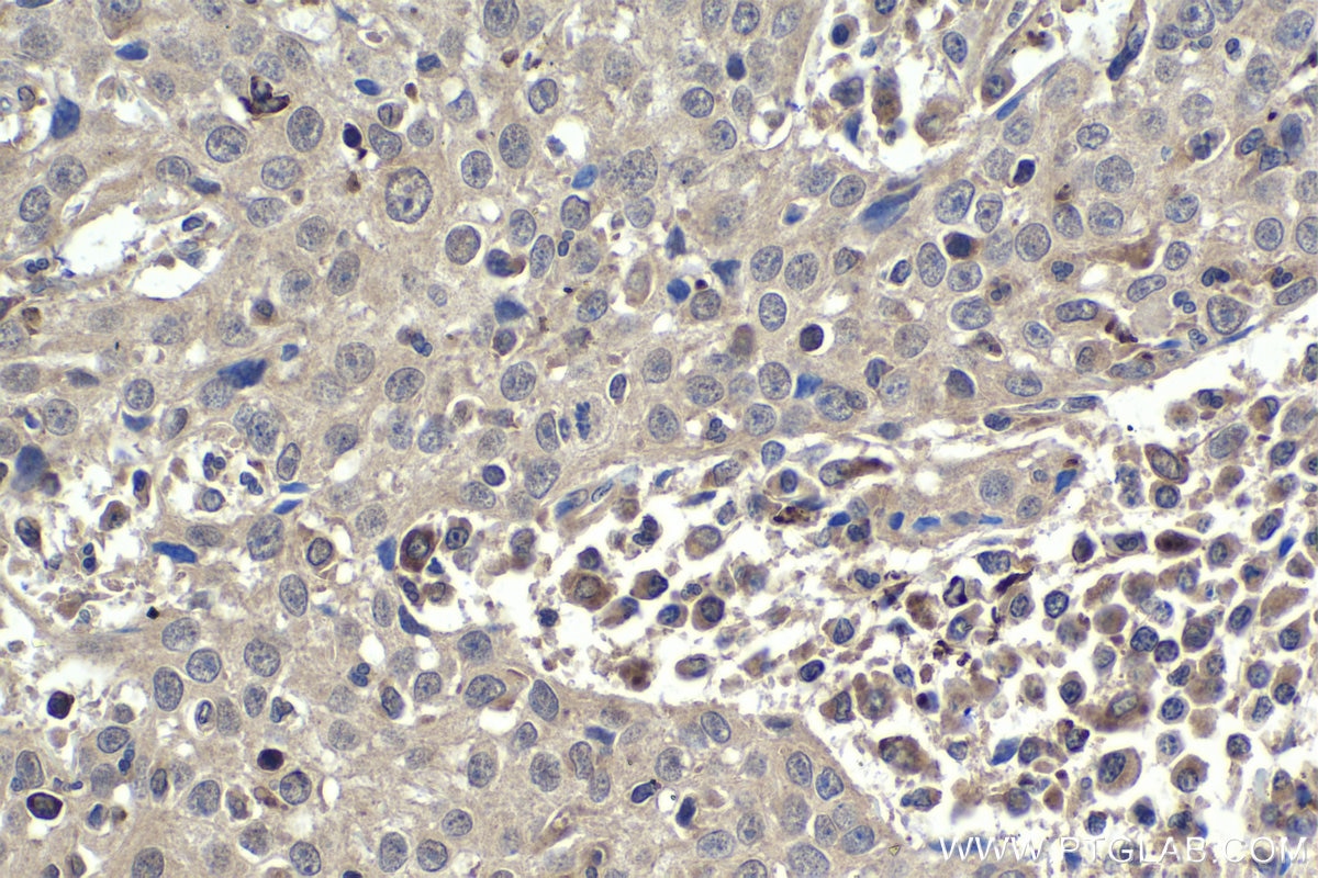 Immunohistochemical analysis of paraffin-embedded human cervical cancer tissue slide using KHC1844 (TWIST2 IHC Kit).