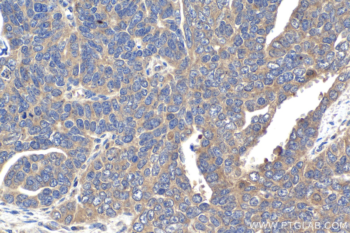 Immunohistochemical analysis of paraffin-embedded human ovary tumor tissue slide using KHC1844 (TWIST2 IHC Kit).