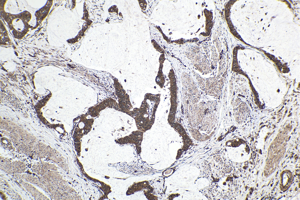 Immunohistochemical analysis of paraffin-embedded human urothelial carcinoma tissue slide using KHC1595 (TXK IHC Kit).