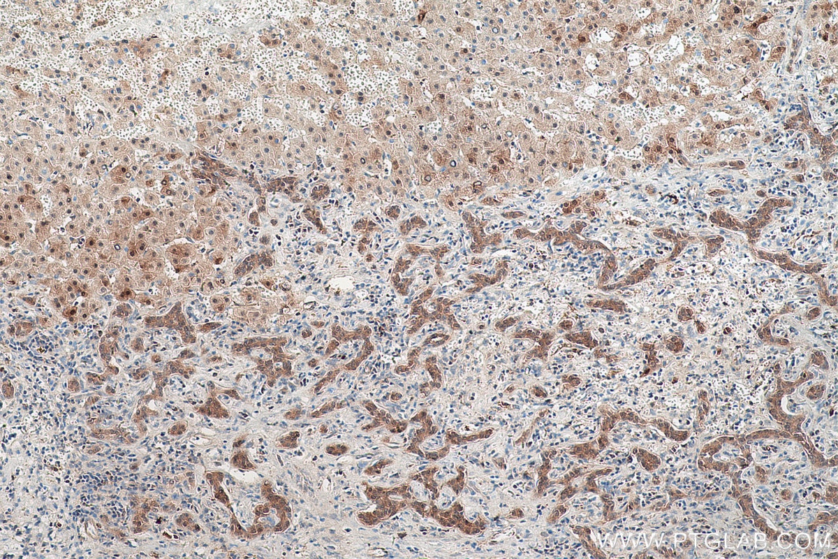 Immunohistochemical analysis of paraffin-embedded human liver cancer tissue slide using KHC0529 (TXN IHC Kit).