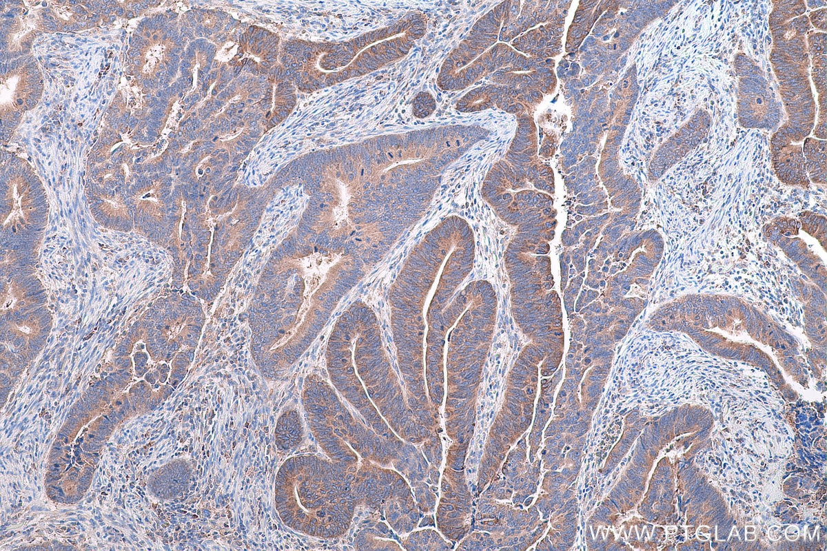 Immunohistochemical analysis of paraffin-embedded human colon cancer tissue slide using KHC0855 (TXNDC12 IHC Kit).