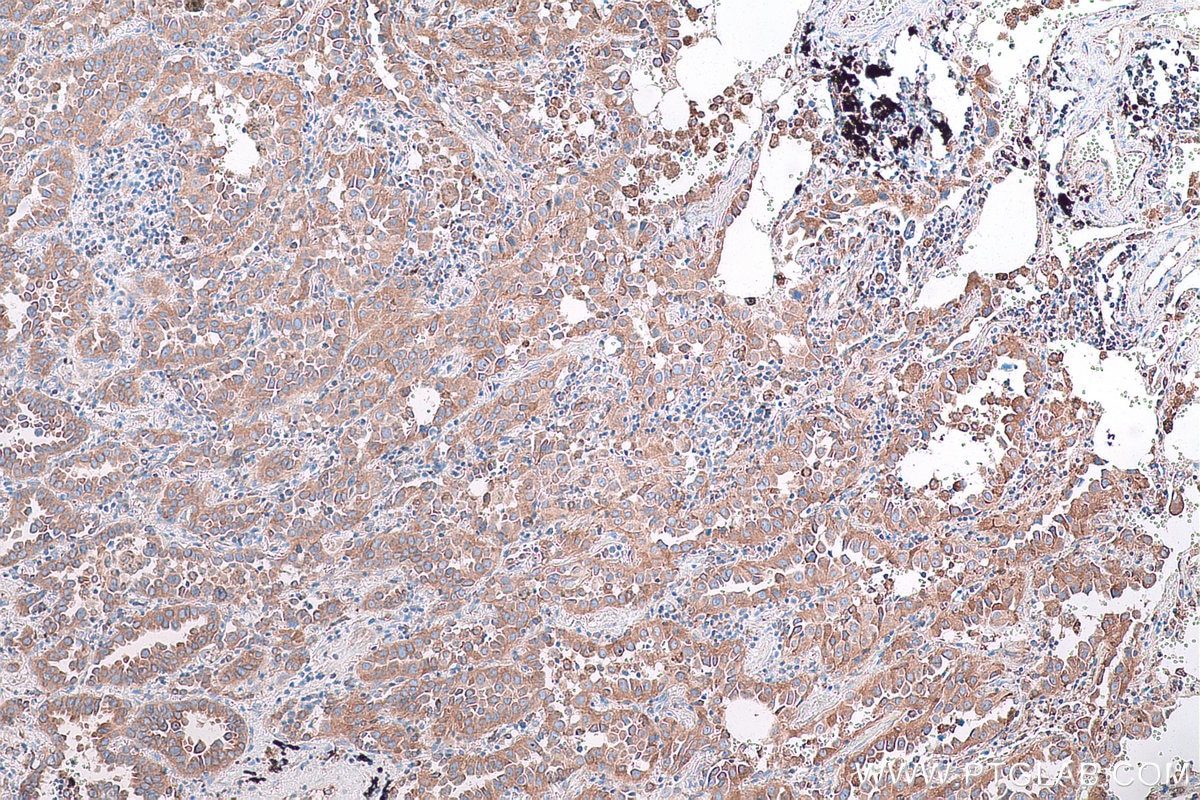 Immunohistochemical analysis of paraffin-embedded human lung cancer tissue slide using KHC0855 (TXNDC12 IHC Kit).