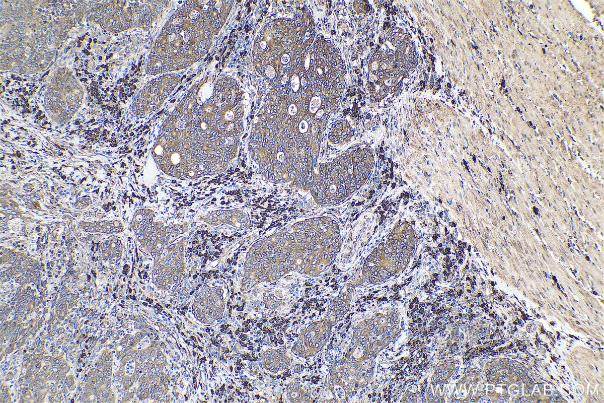 Immunohistochemical analysis of paraffin-embedded human colon cancer tissue slide using KHC0685 (TXNDC5 IHC Kit).