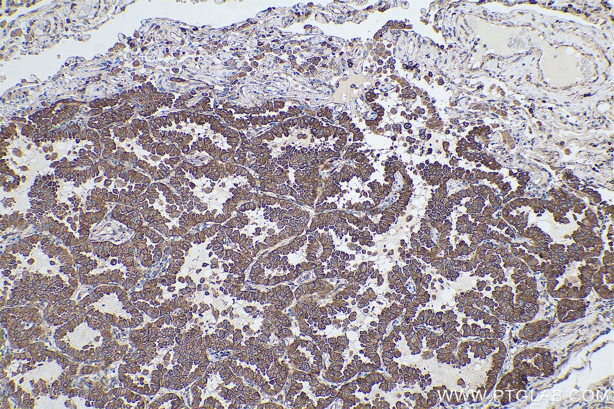 Immunohistochemical analysis of paraffin-embedded human lung cancer tissue slide using KHC0685 (TXNDC5 IHC Kit).