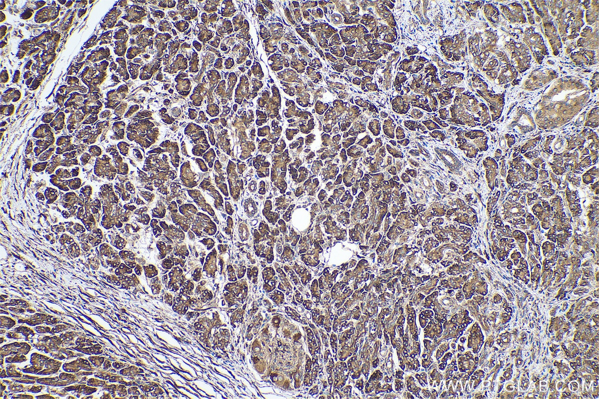 Immunohistochemical analysis of paraffin-embedded human pancreas cancer tissue slide using KHC0685 (TXNDC5 IHC Kit).