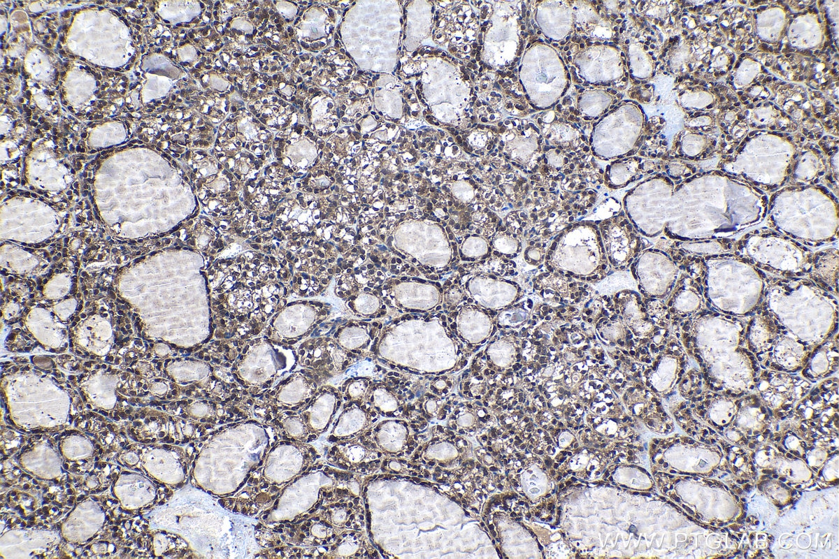 Immunohistochemical analysis of paraffin-embedded human thyroid cancer tissue slide using KHC1303 (TXNL1 IHC Kit).