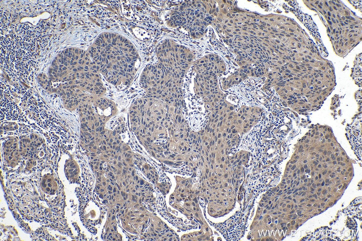 Immunohistochemical analysis of paraffin-embedded human lung cancer tissue slide using KHC1303 (TXNL1 IHC Kit).