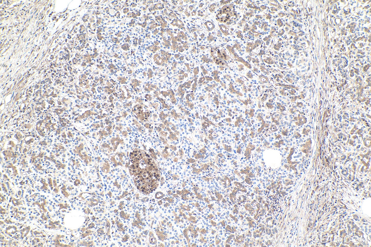 Immunohistochemical analysis of paraffin-embedded human pancreas cancer tissue slide using KHC1766 (TXNRD1 IHC Kit).