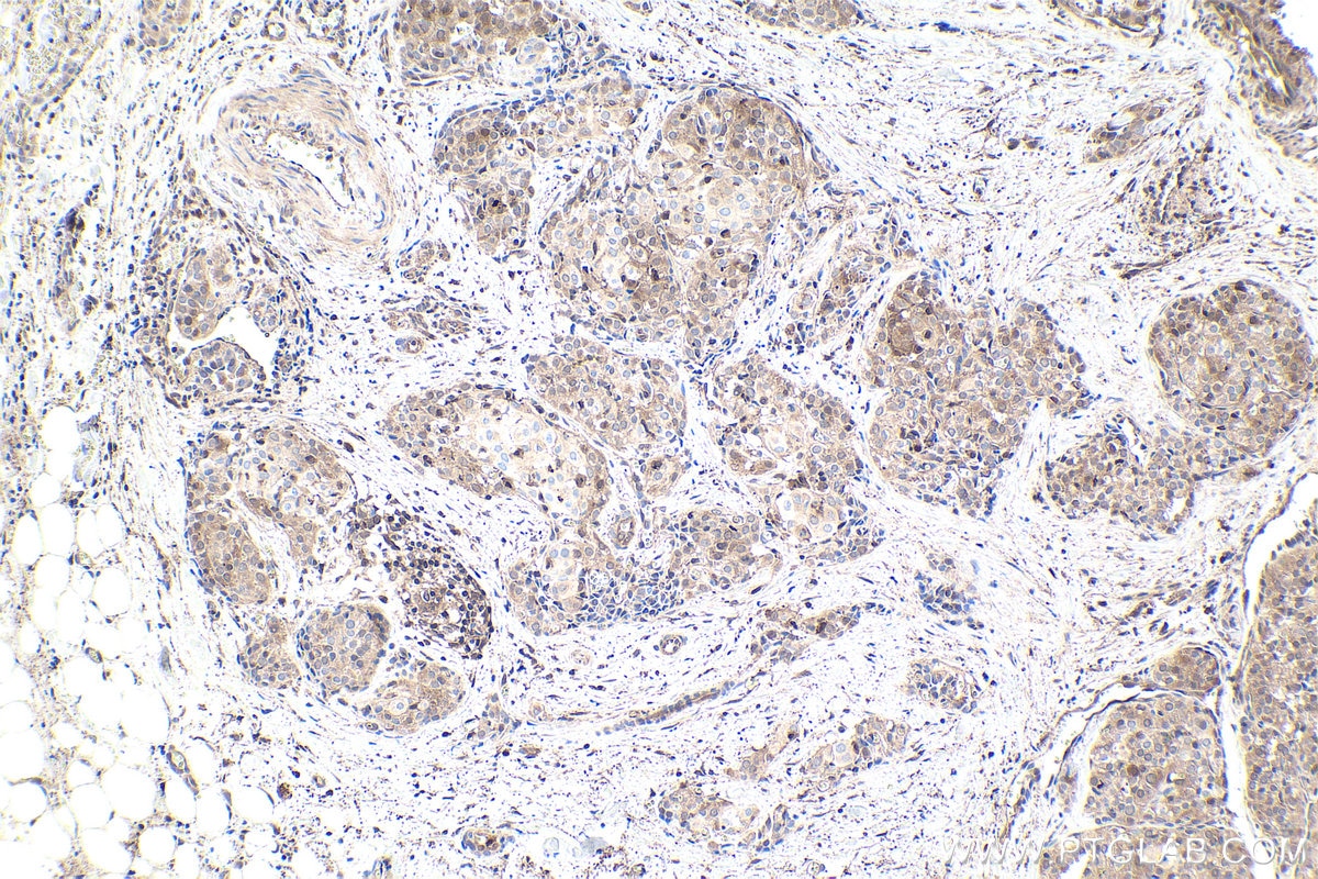 Immunohistochemical analysis of paraffin-embedded human thyroid cancer tissue slide using KHC1766 (TXNRD1 IHC Kit).