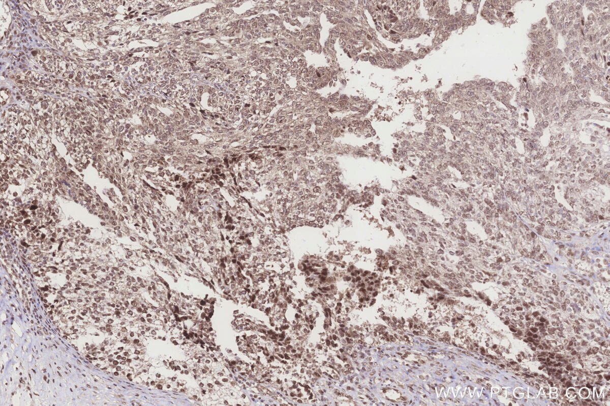 Immunohistochemical analysis of paraffin-embedded human ovary cancer tissue slide using KHC3283 (TXNRD3 IHC Kit).