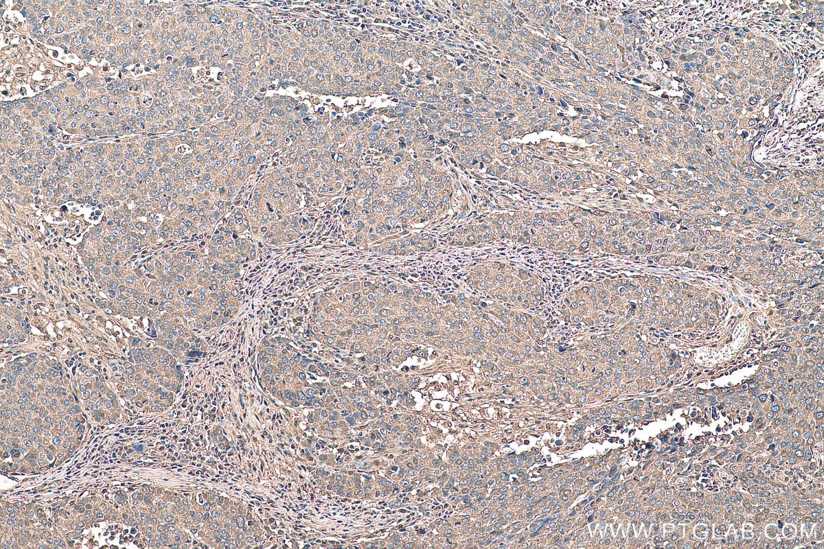 Immunohistochemical analysis of paraffin-embedded human stomach cancer tissue slide using KHC0926 (TYMP IHC Kit).