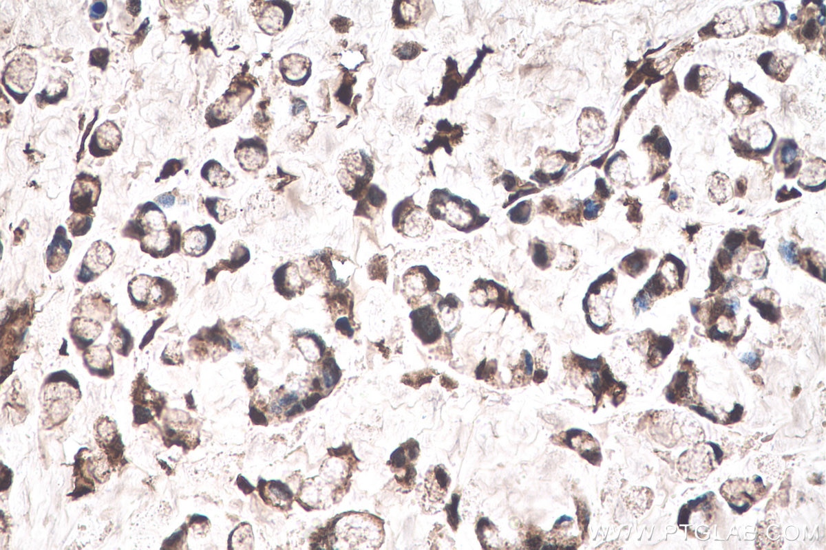 Immunohistochemical analysis of paraffin-embedded human colon cancer tissue slide using KHC0926 (TYMP IHC Kit).