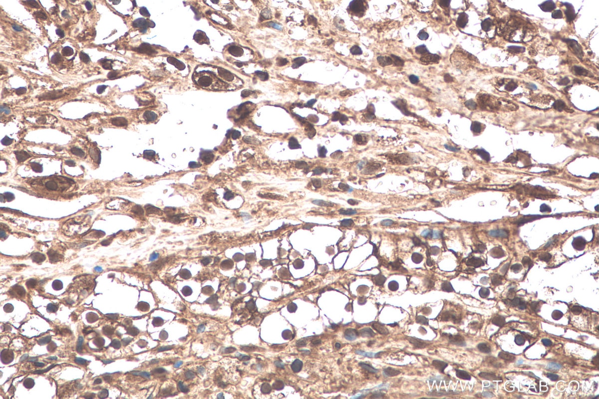 Immunohistochemical analysis of paraffin-embedded human renal cell carcinoma tissue slide using KHC0926 (TYMP IHC Kit).