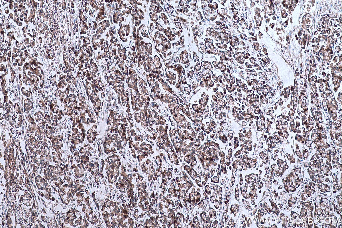 Immunohistochemical analysis of paraffin-embedded human colon cancer tissue slide using KHC0649 (TYMS IHC Kit).