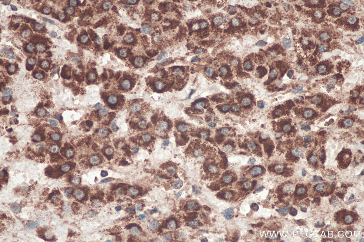Immunohistochemical analysis of paraffin-embedded human liver cancer tissue slide using KHC0469 (TYW3 IHC Kit).