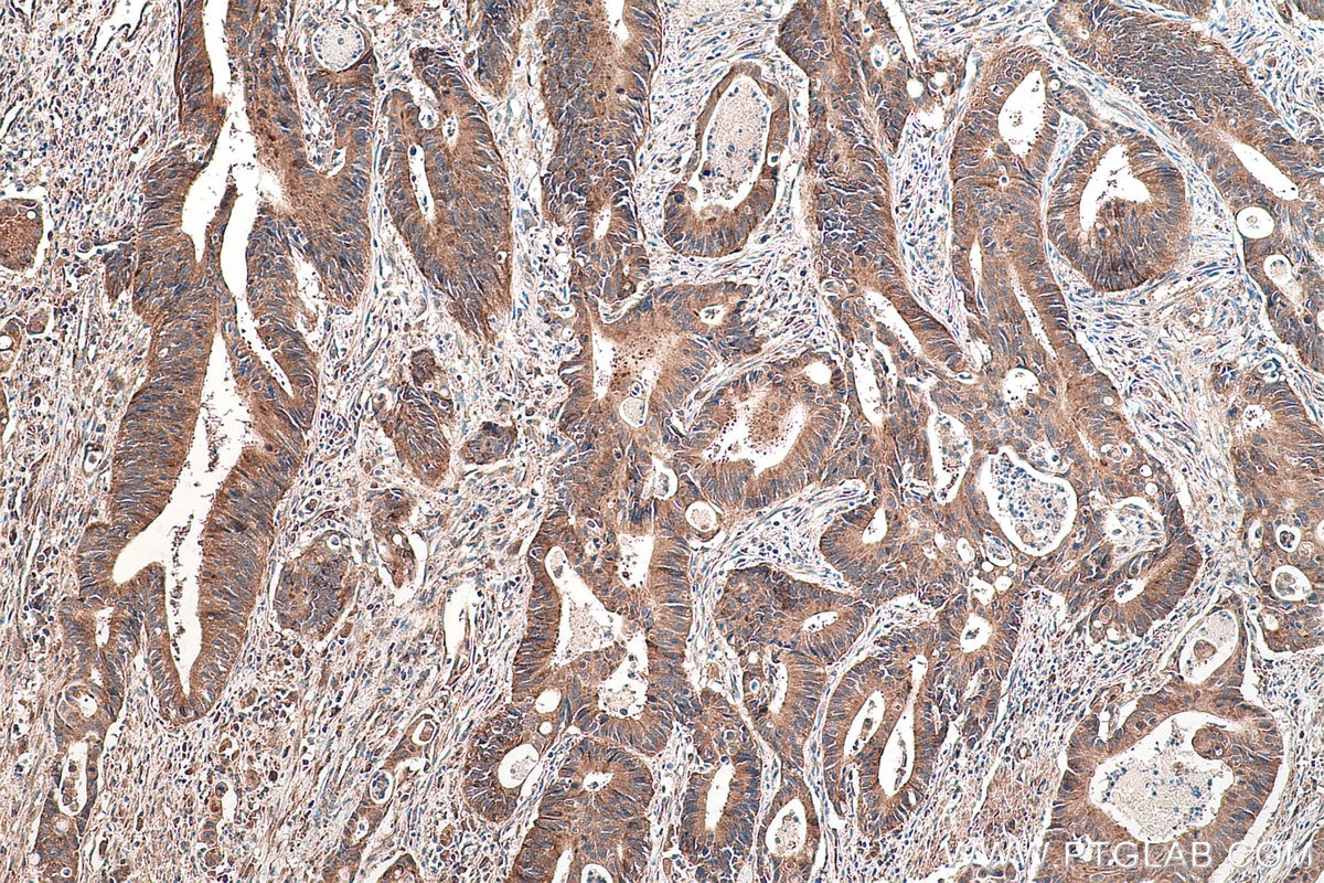 Immunohistochemical analysis of paraffin-embedded human colon cancer tissue slide using KHC0469 (TYW3 IHC Kit).
