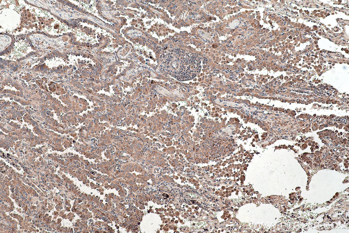 Immunohistochemical analysis of paraffin-embedded human lung cancer tissue slide using KHC0469 (TYW3 IHC Kit).