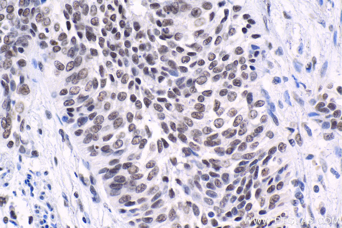 Immunohistochemical analysis of paraffin-embedded human urothelial carcinoma tissue slide using KHC1661 (U2AF1 IHC Kit).