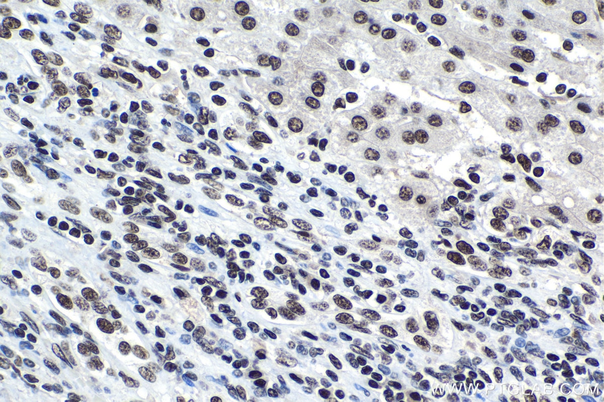 Immunohistochemical analysis of paraffin-embedded human liver cancer tissue slide using KHC1566 (U2AF2 IHC Kit).
